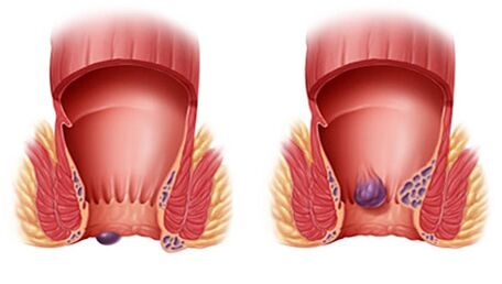 Proctonic helps with all types of hemorrhoids